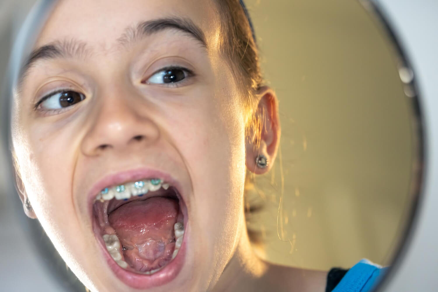 Maloclusiones dentales: qué son, causas y tratamientos
