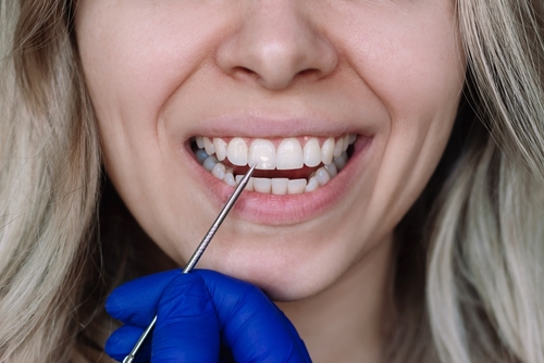¿Por qué salen manchas blancas en los dientes?
