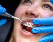 ¿Qué es la ortodoncia y la endodoncia? Diferencias, tratamientos y beneficios