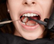 Sellado dental: todo lo que debes saber