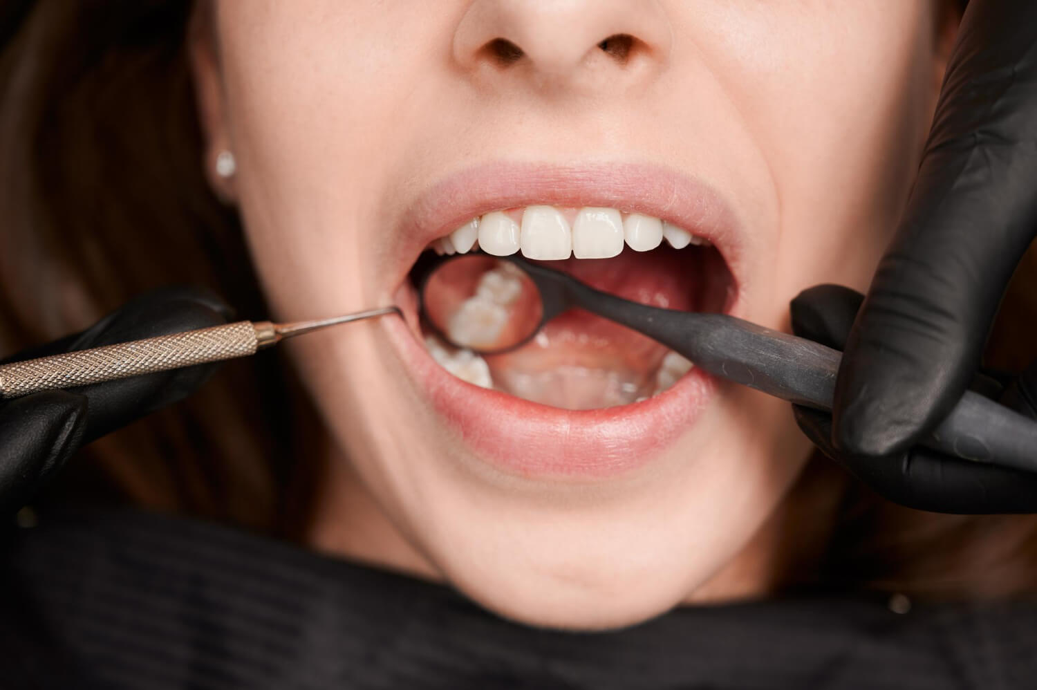 Sellado dental: todo lo que debes saber