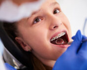 Estos son los problemas más comunes de los brackets dentales