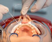 retenedor fijo dental