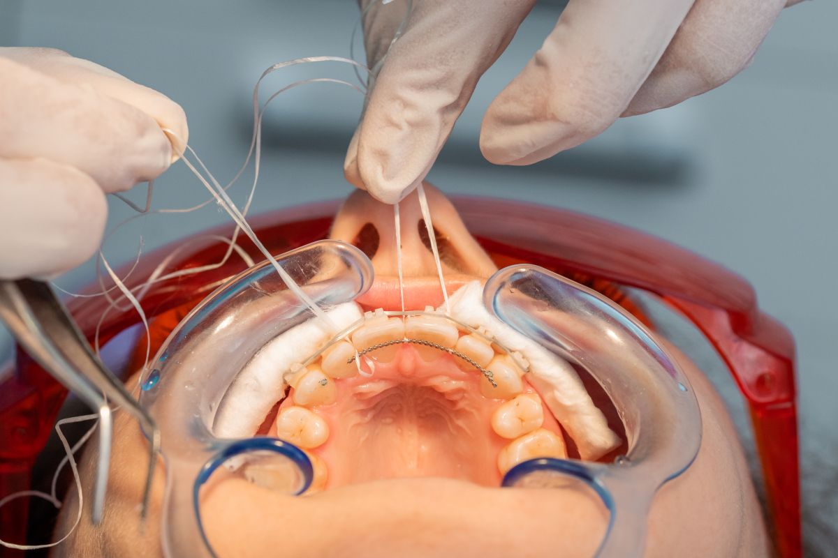 retenedor fijo dental